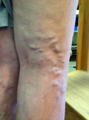 Varicose Veins