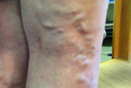 Understanding Varicose Veins